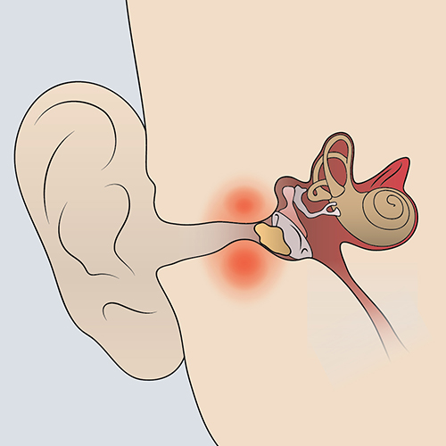 An illustration of the inner ear showing conductive hearing loss