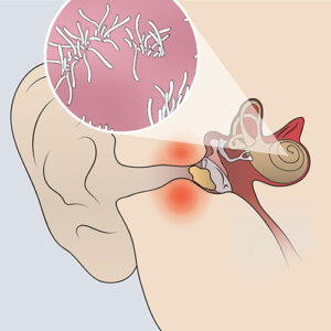 An illustration of the inner ear showing mixed hearing loss