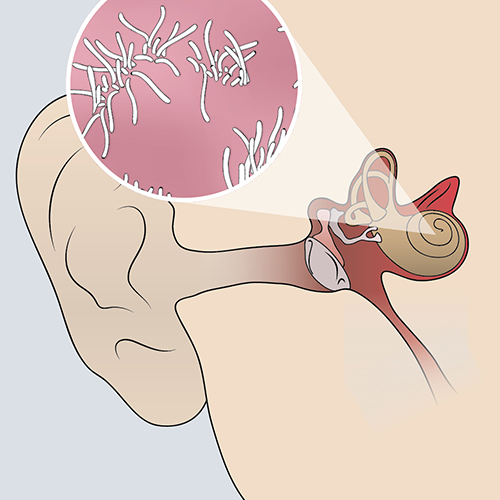 An illustration of the inner ear showing sensorineural hearing loss